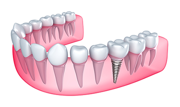 dental implants | Dentist in Chicago, IL | Lake View Dental Associates