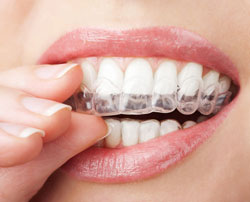 Orthodontics (invisalign) | Dentist in Chicago, IL | Lake View Dental Associates